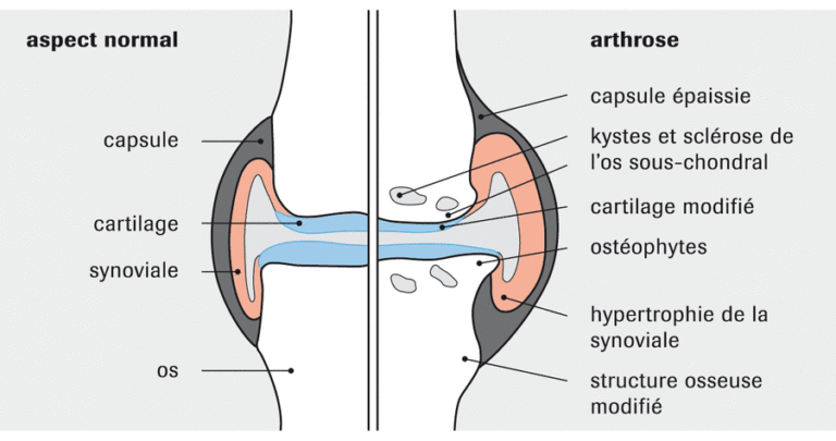 Arthrose, causes et conséquences – Swiss Alp Nutrition